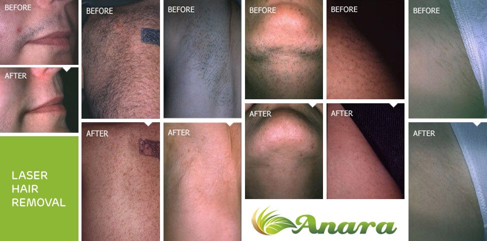 Permanent Laser Hair Reduction in New Jersey