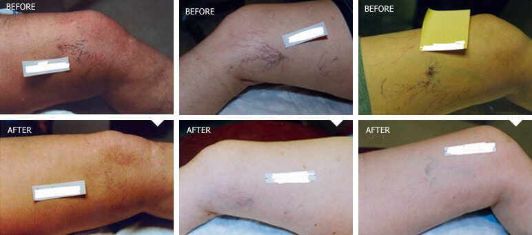 Laser Vein Removal in East Brunswick, NJ | Anara Medspa