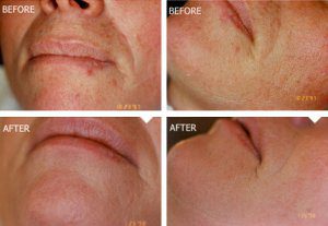 Medical Microdermabrasion - Before-After