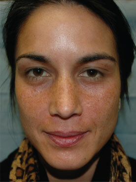 Before Vi-peel-1, Permanent Laser Hair Reduction in NJ | Anara Medspa