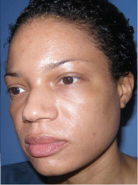 After Vi-peel-3, Permanent Laser Hair Reduction in NJ | Anara Medspa