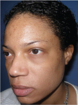 Before Vi-peel-3, Permanent Laser Hair Reduction in NJ | Anara Medspa