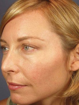 After Vi-peel-5, Permanent Laser Hair Reduction in NJ | Anara Medspa