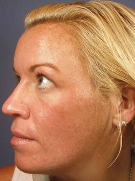 After Vi-peel-7, Permanent Laser Hair Reduction in NJ | Anara Medspa