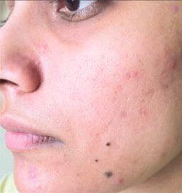 After Acne Treatment2, Permanent Laser Hair Reduction in NJ | Anara Medspa