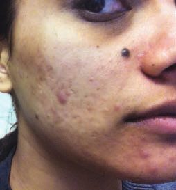 Before Acne Treatment, Permanent Laser Hair Reduction in NJ | Anara Medspa