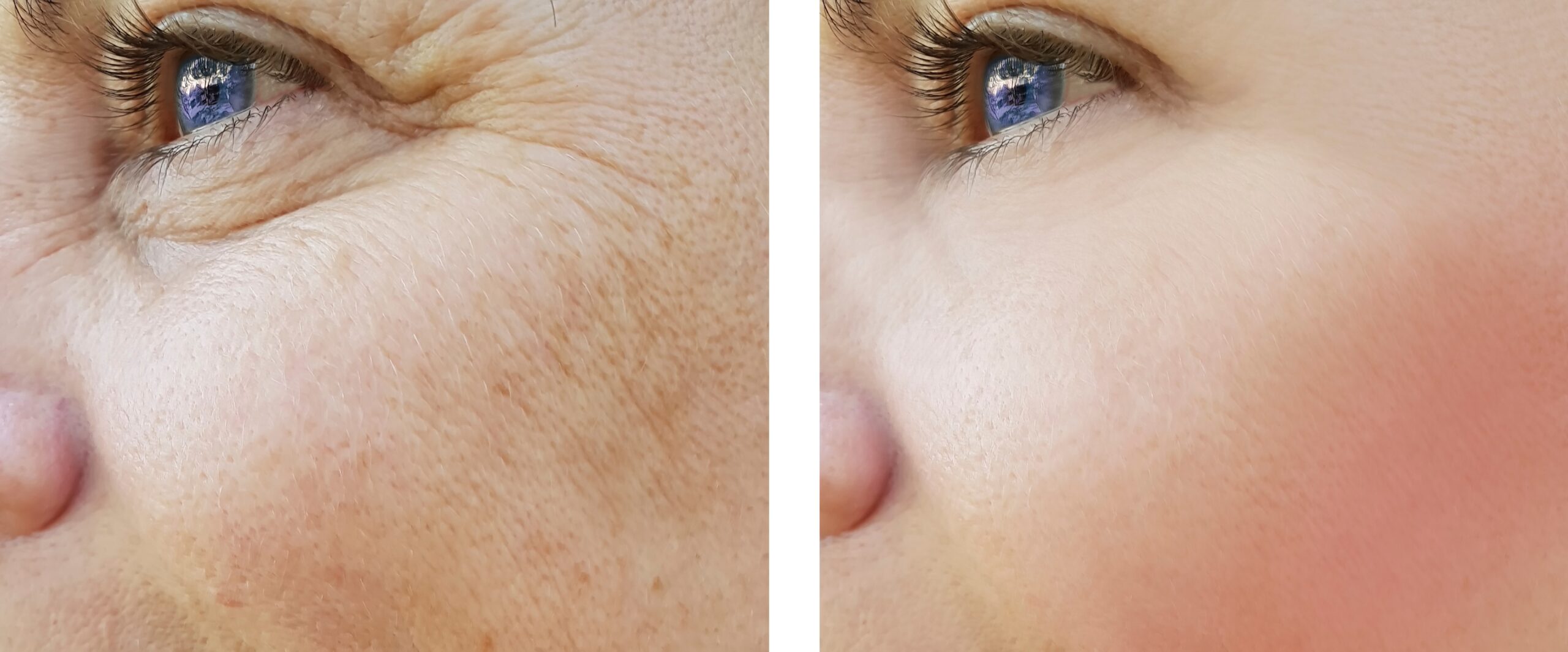 IPL Photofacial laser treatment in New Jersey