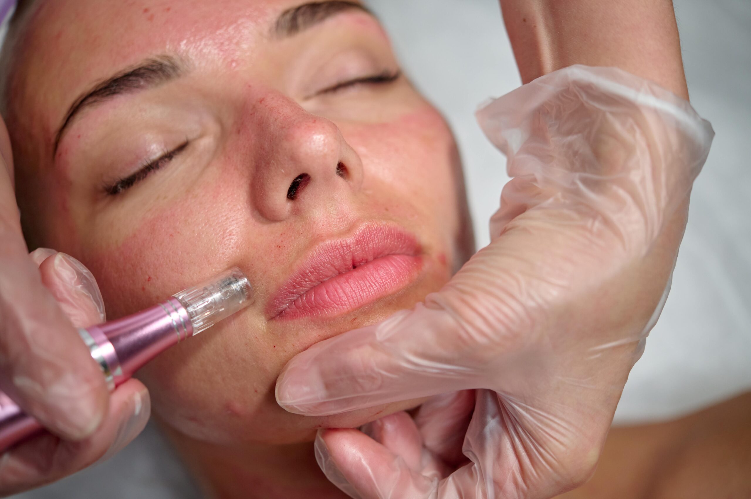 Achieve Flawless Skin With Microneedling In Nj A Comprehensive Guide All Area Over Head