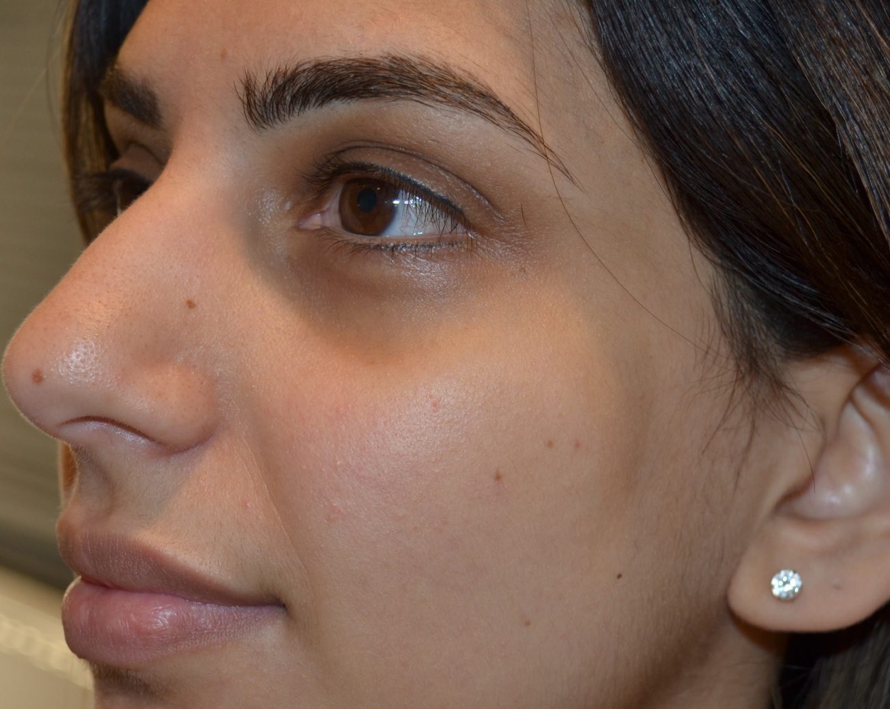 Face of a young woman after PRP Facelift in East Brunswick NJ