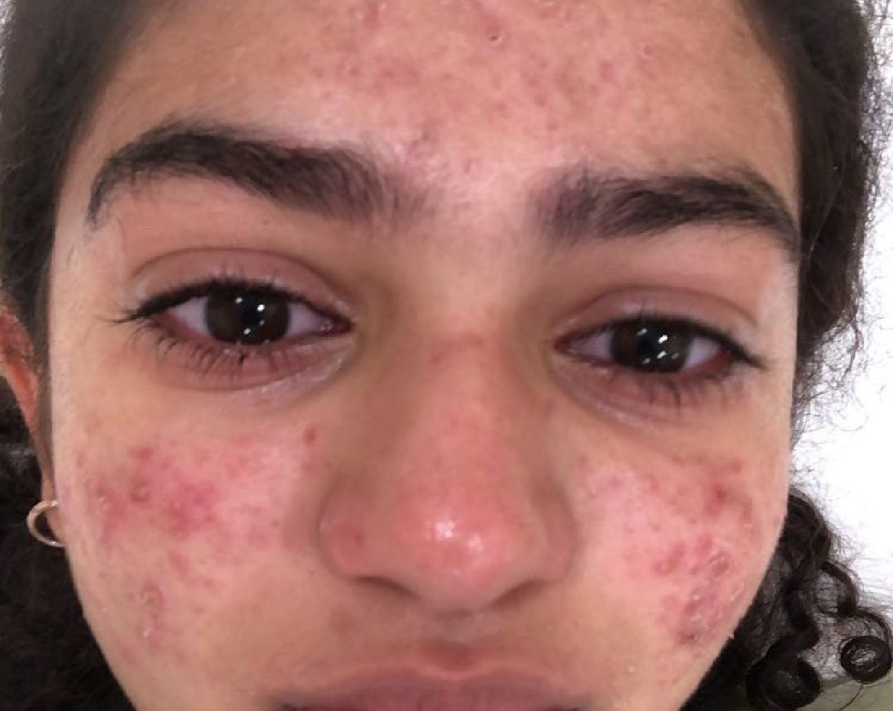 Severe acne in the face of a girl before treatment at Anara Medspa in East Brunswick NJ