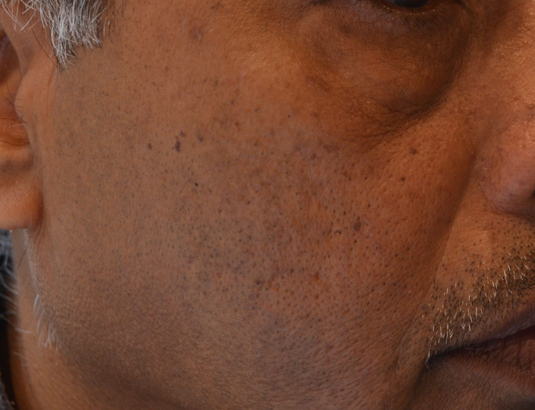 Skin tags resolved after one laser treatment