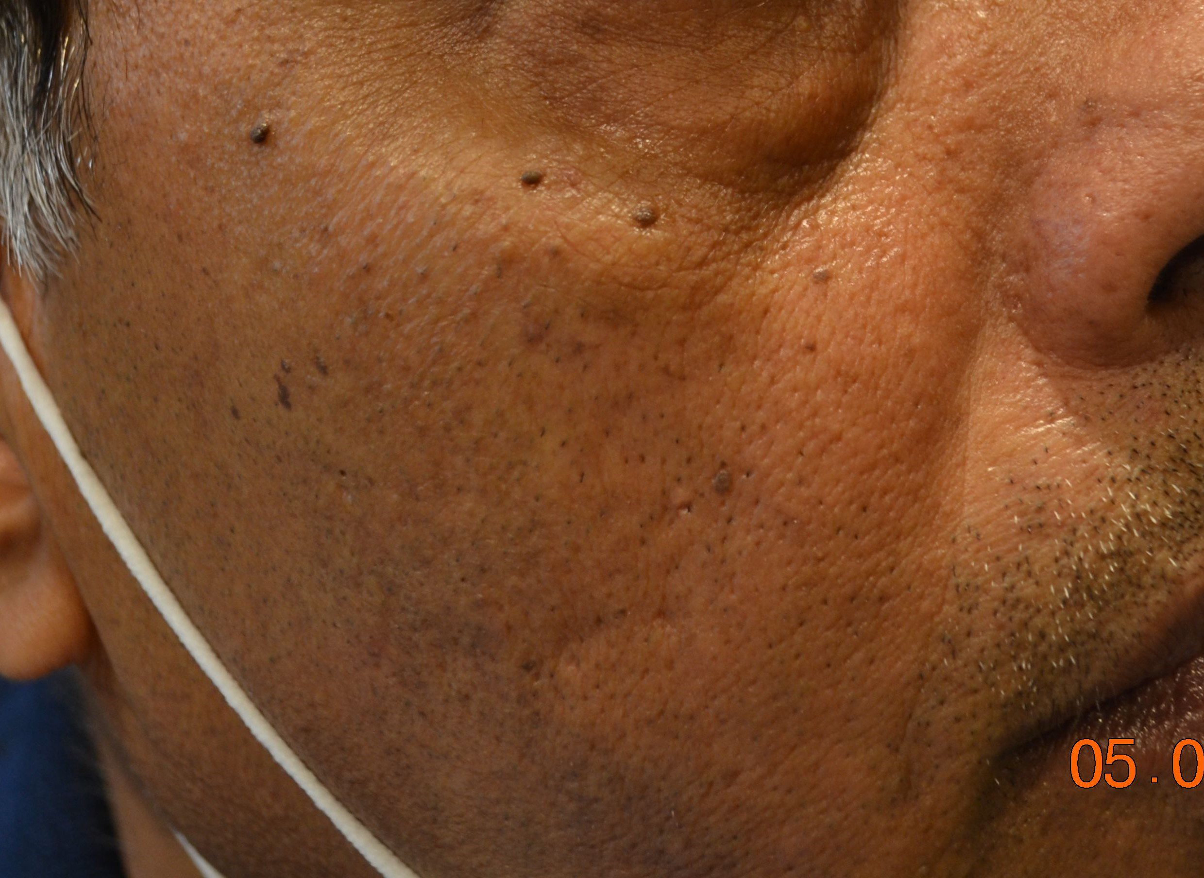 Skin tags on right side of face
