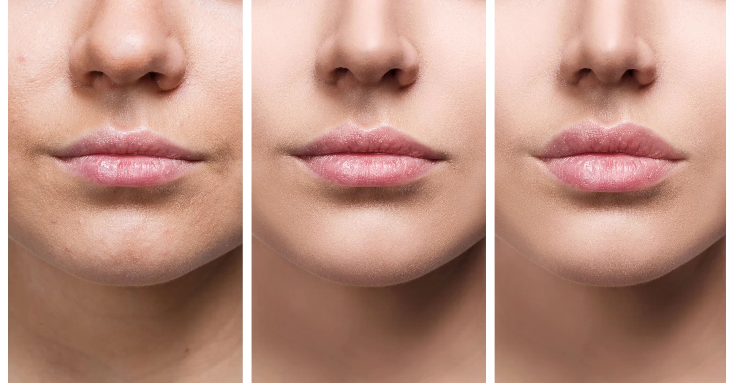 Lip Filler Treatments in New Jersey