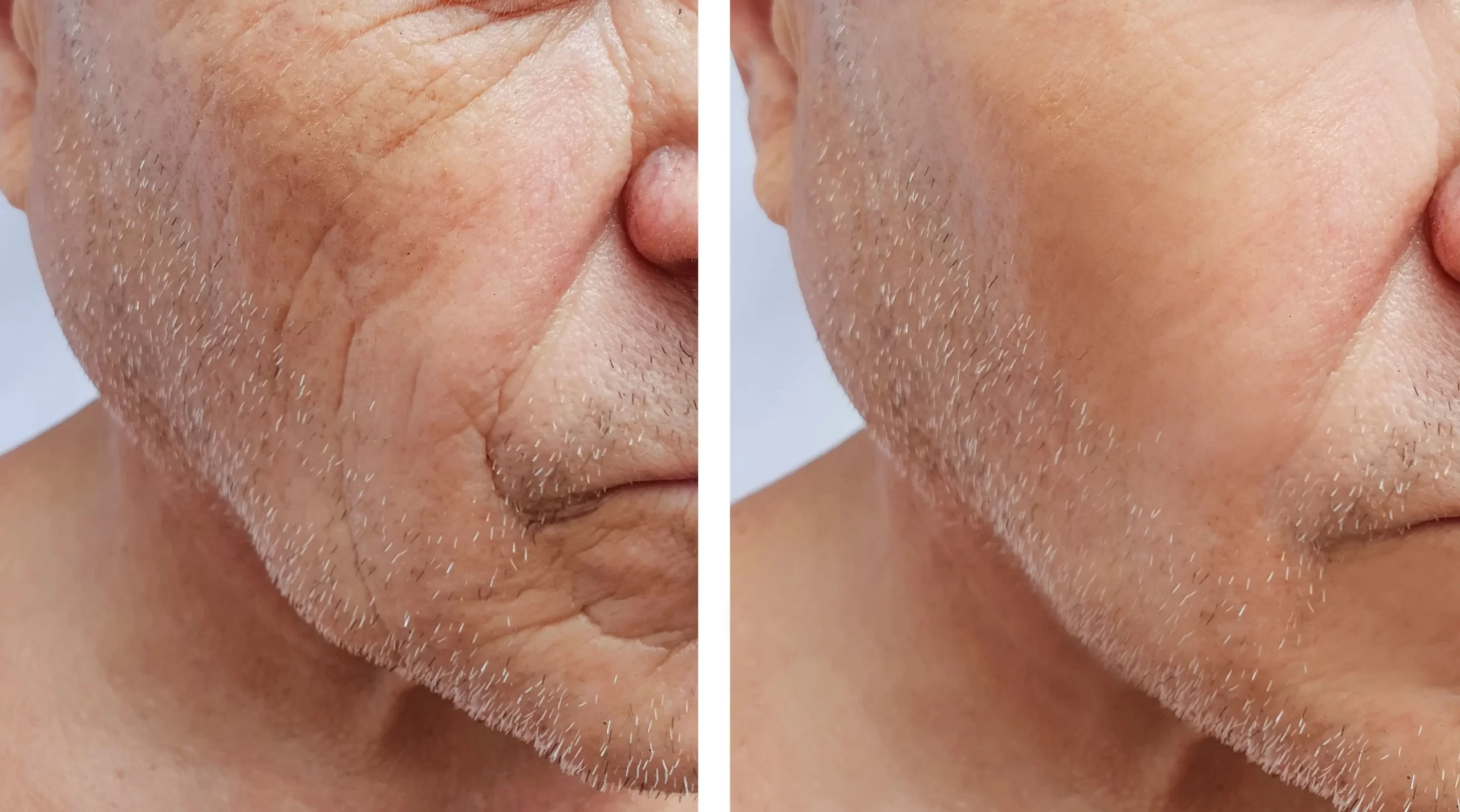 Sculptra treatment (Before-After)