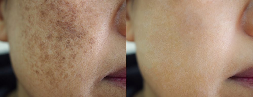 Hyperpigmentation Treatment in New Jersey ( Before-After) | Anara Medspa