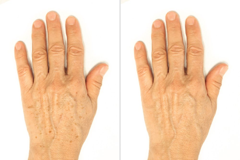 Hand Rejuvenation Treatment