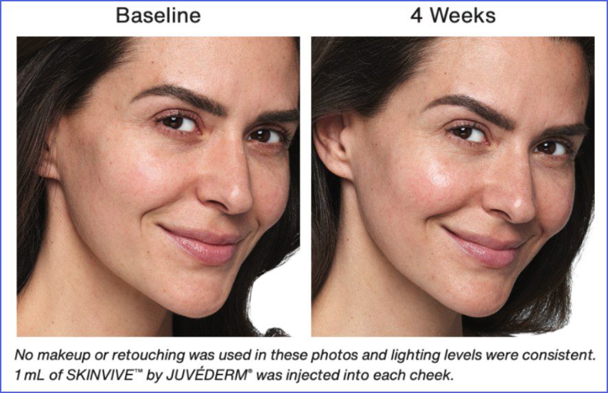 Juvederm Treatment in New jersey