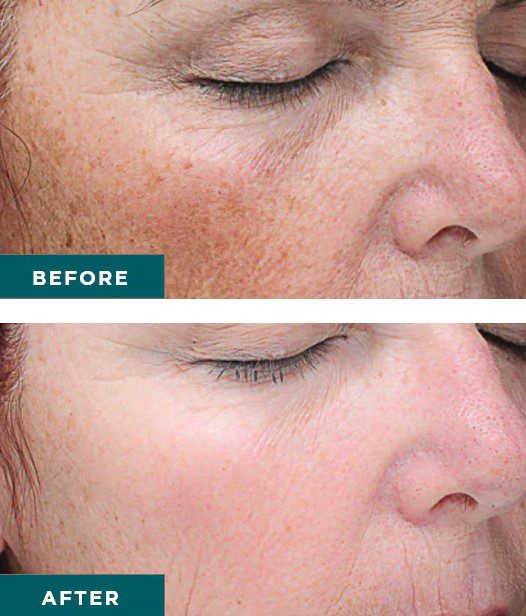 Vi Peel Treatment before and after results Anara Medspa