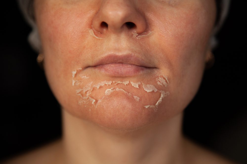 chemical Peel