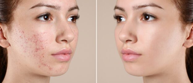 Acne treatment in new jersey