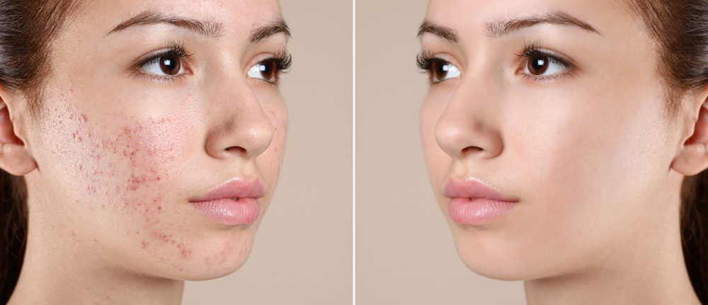 Acne treatment in new jersey