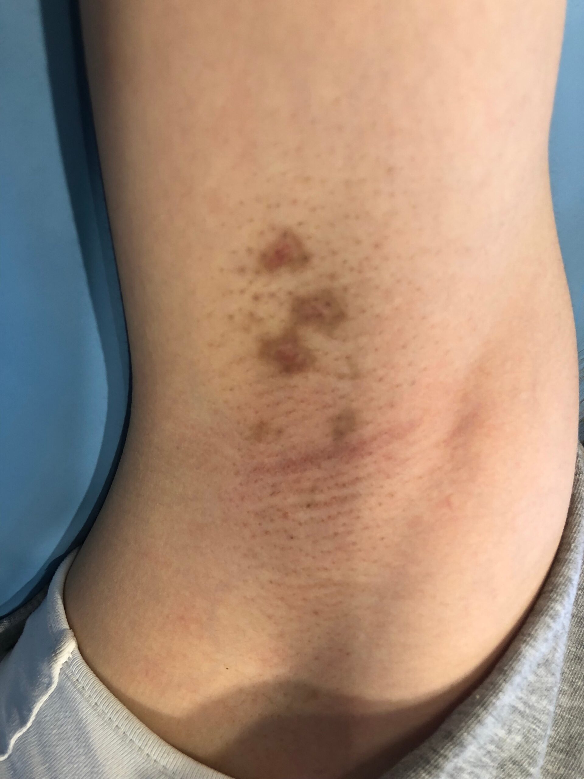 Hypopigmentation Treatment