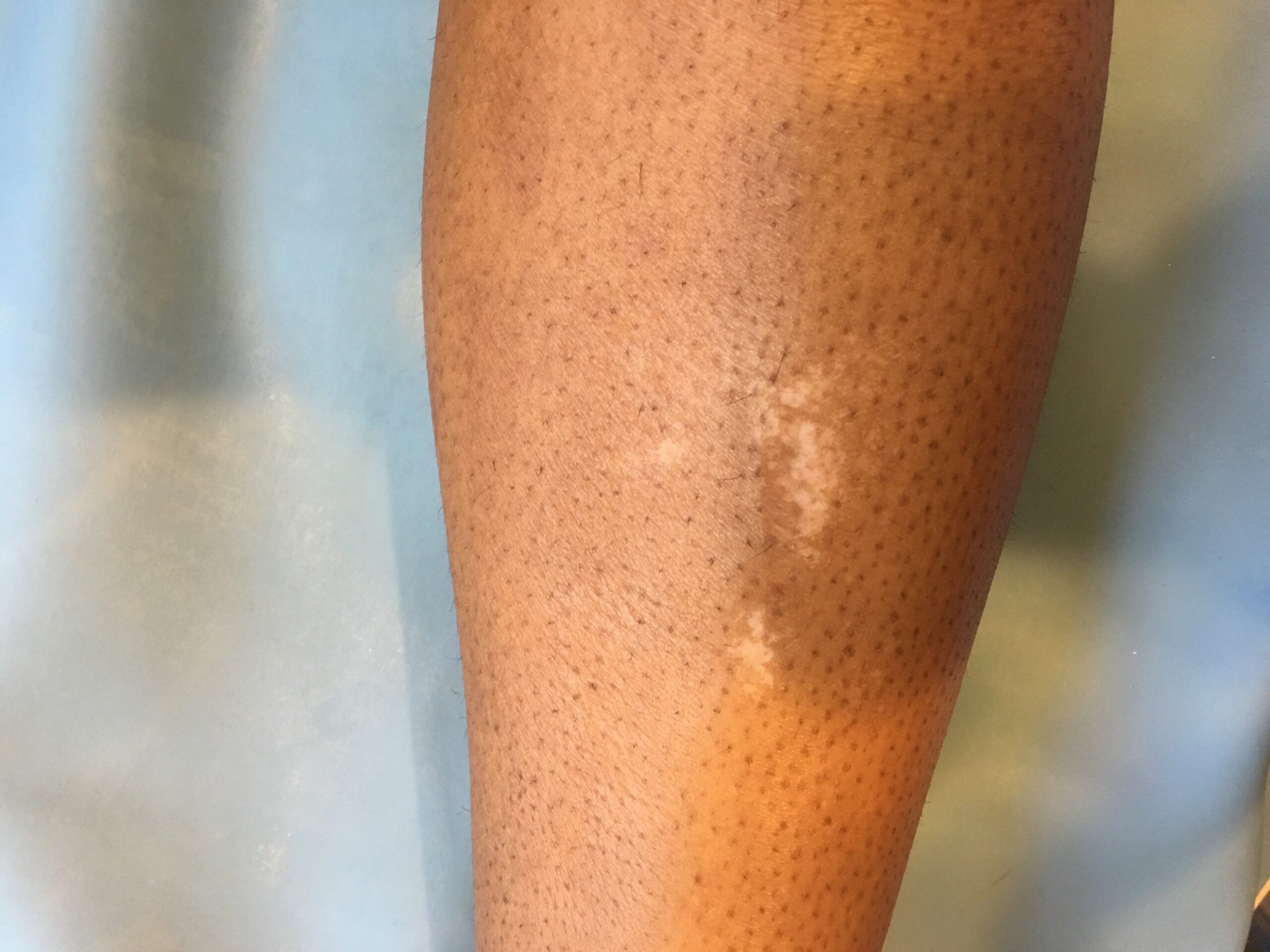 Hypopigmentation 