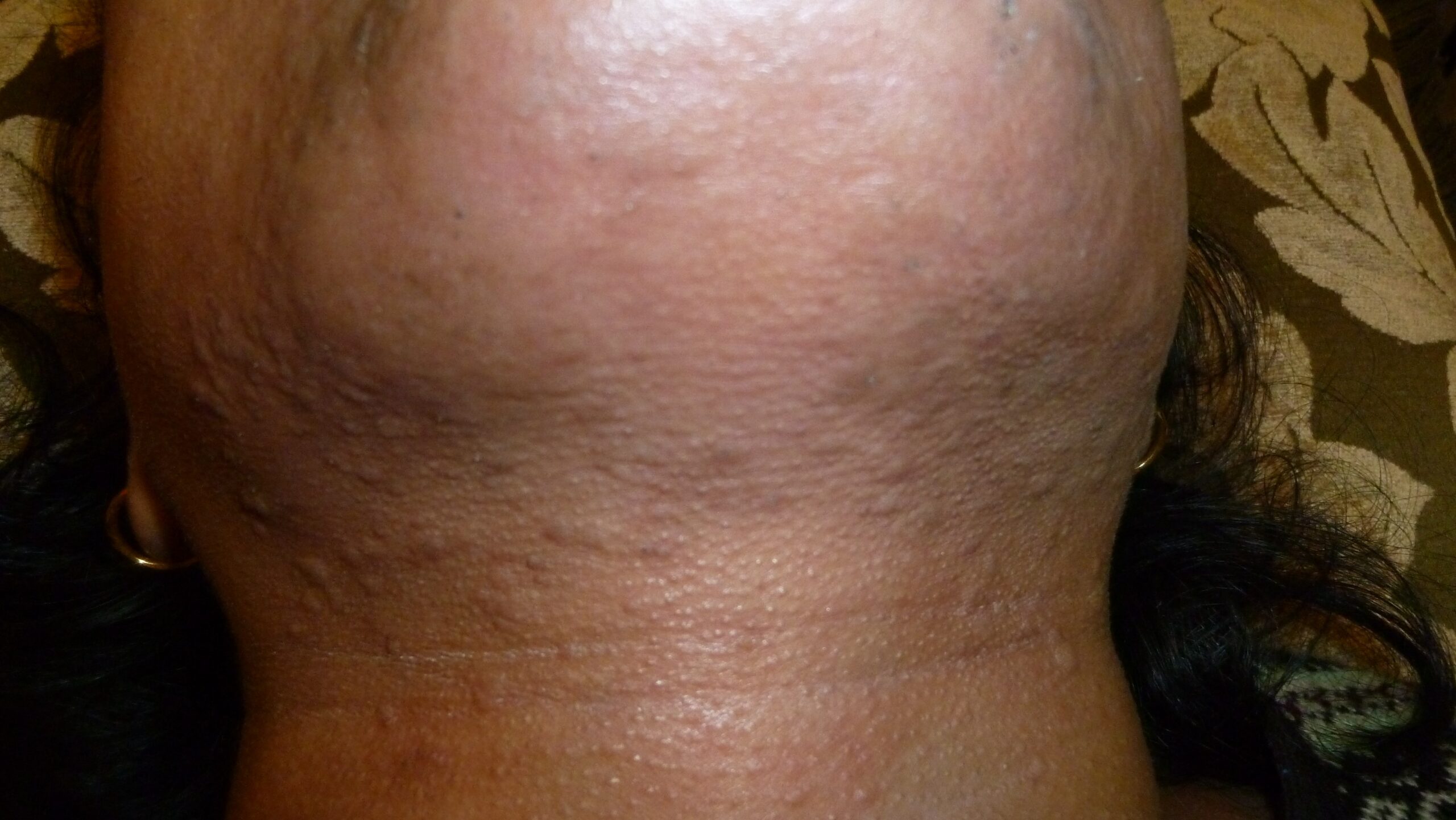 Hypopigmentation 