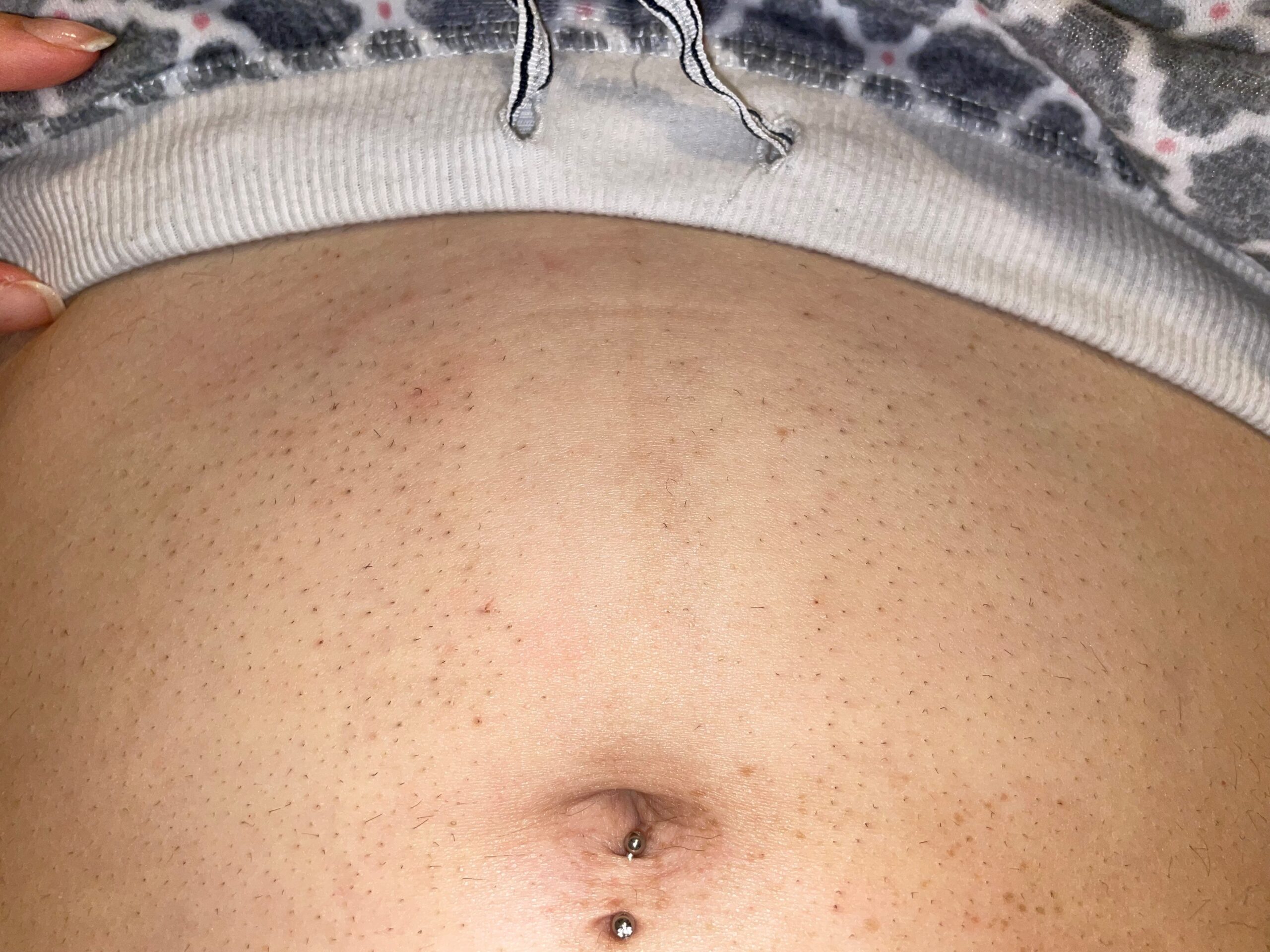 Normal Spot laser hair Removal